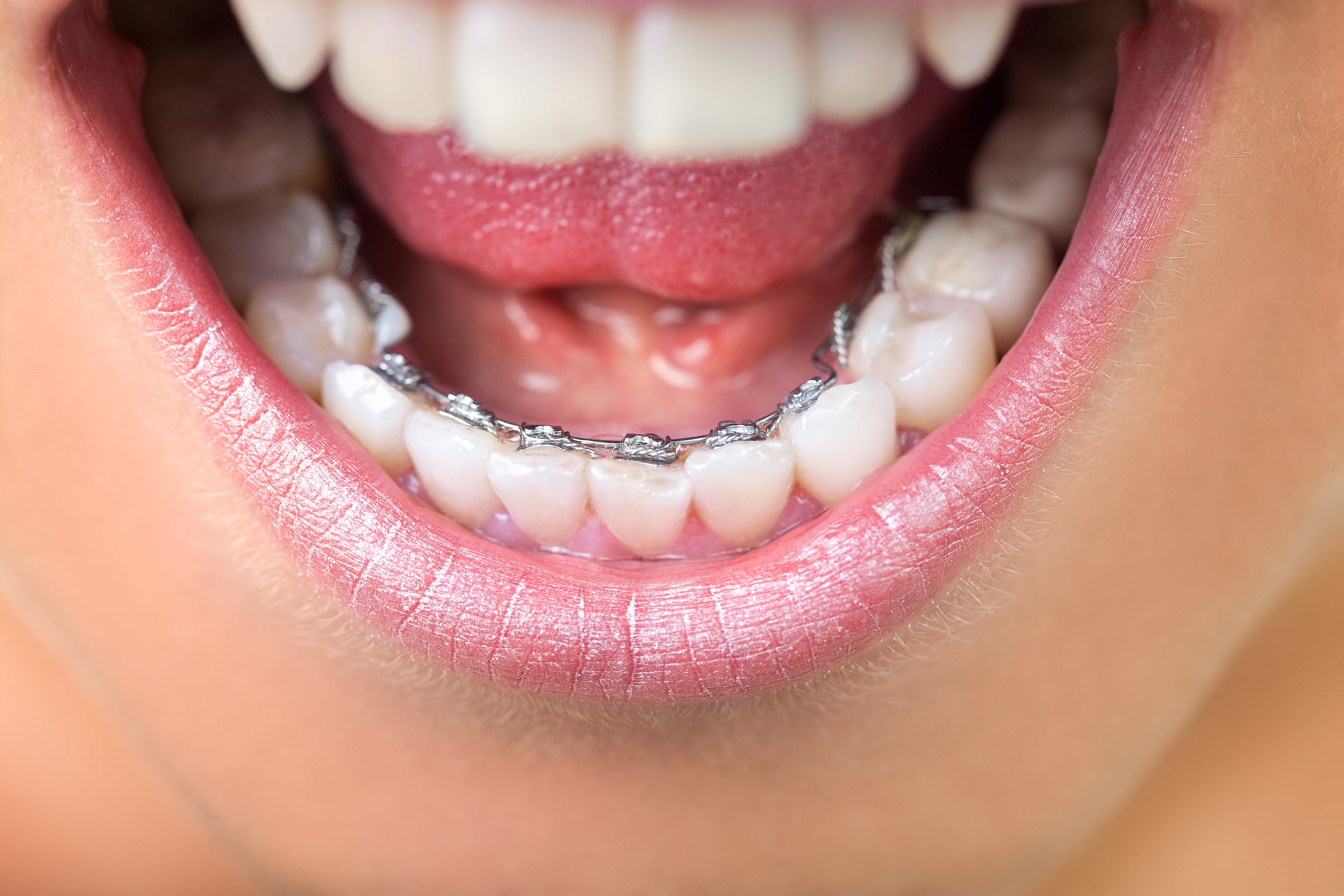 Aparat dentar lingual Cluj