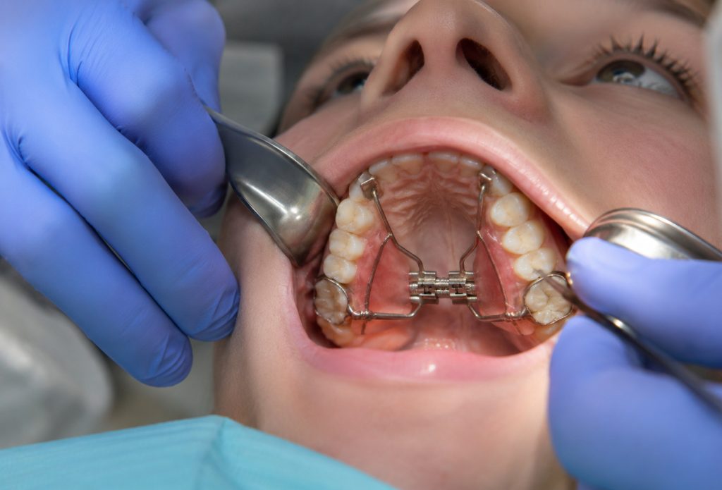 Plan ortodontic după tratamentul cu disjunctor dentar realizat la STOMESTET Cluj