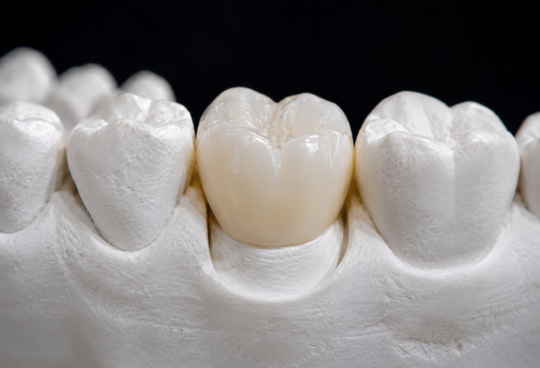 Coroană dentară din zirconiu cu aspect natural realizată la STOMESTET Cluj
