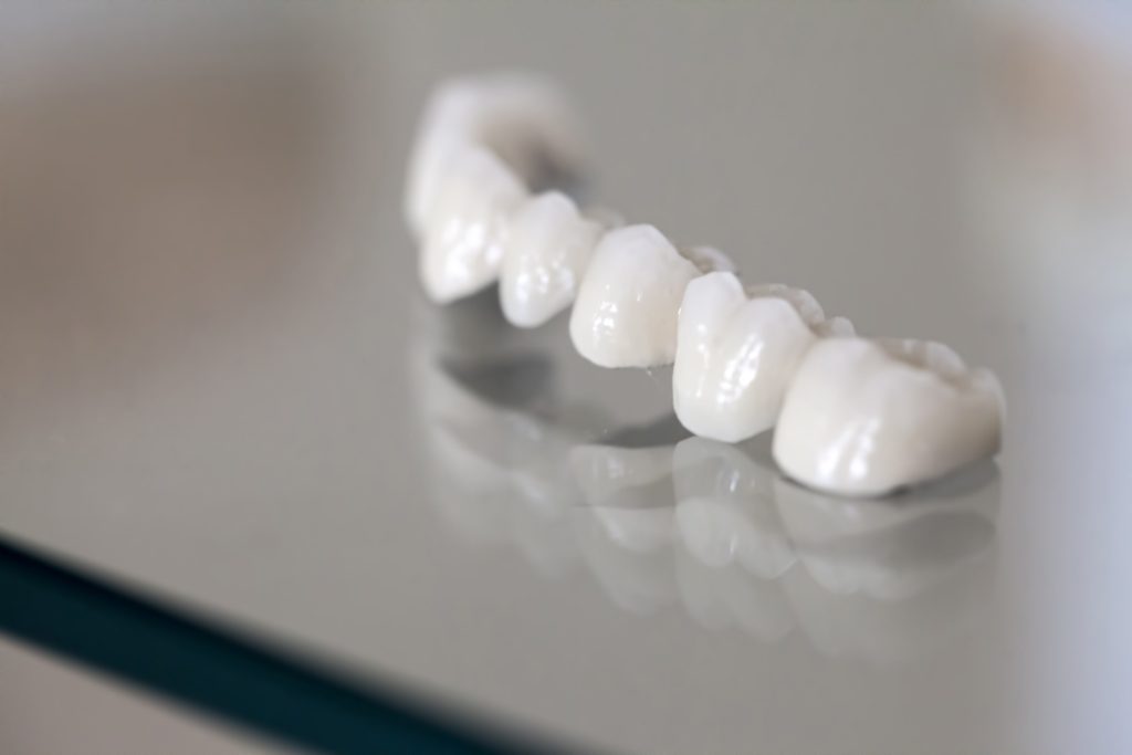 Punte dentară din zirconiu cu aspect natural realizată la STOMESTET Cluj