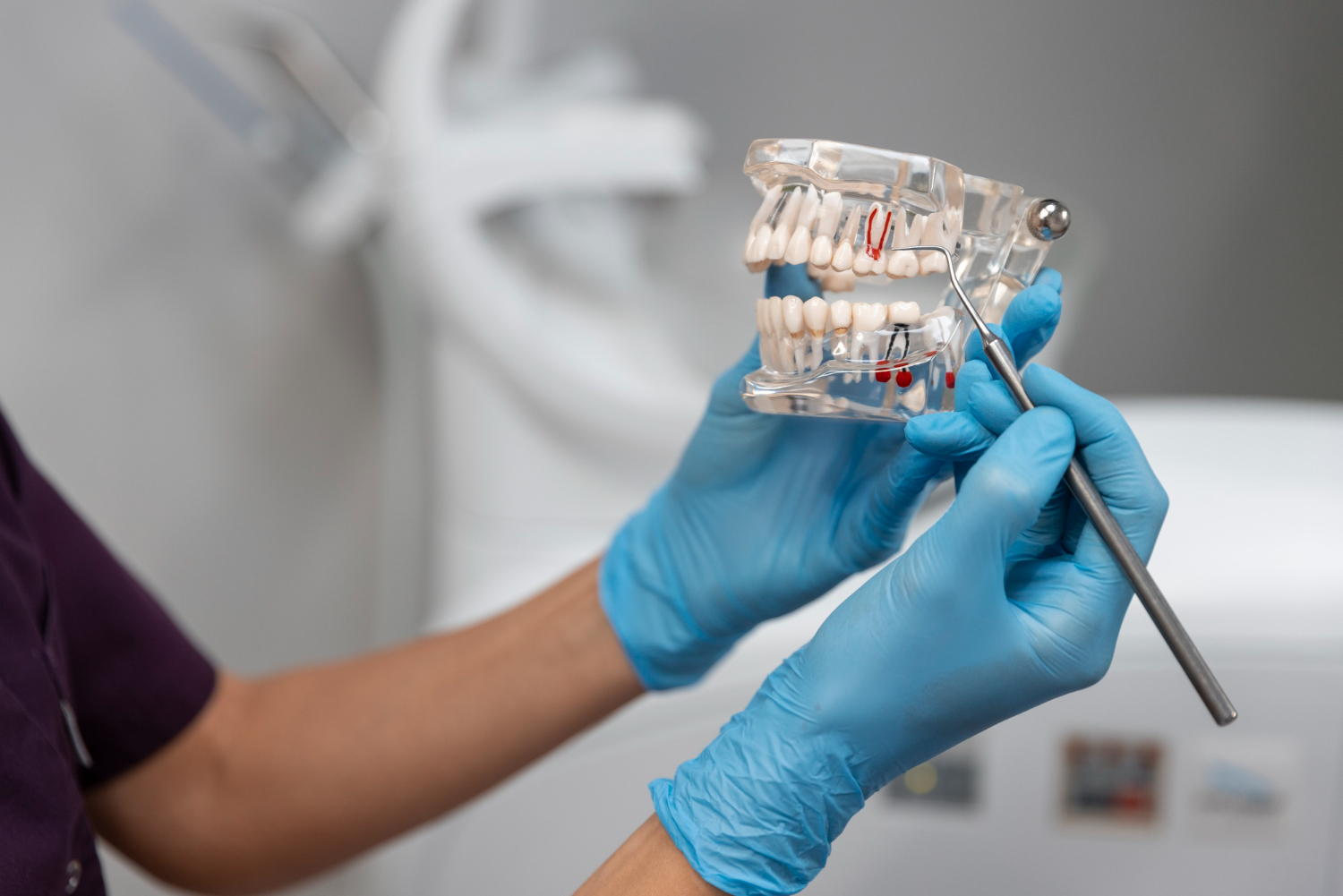 Ce este pivotul dentar și când ai nevoie de el