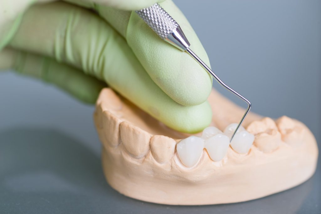 Punte dentară fixă pentru înlocuirea dinților lipsă
