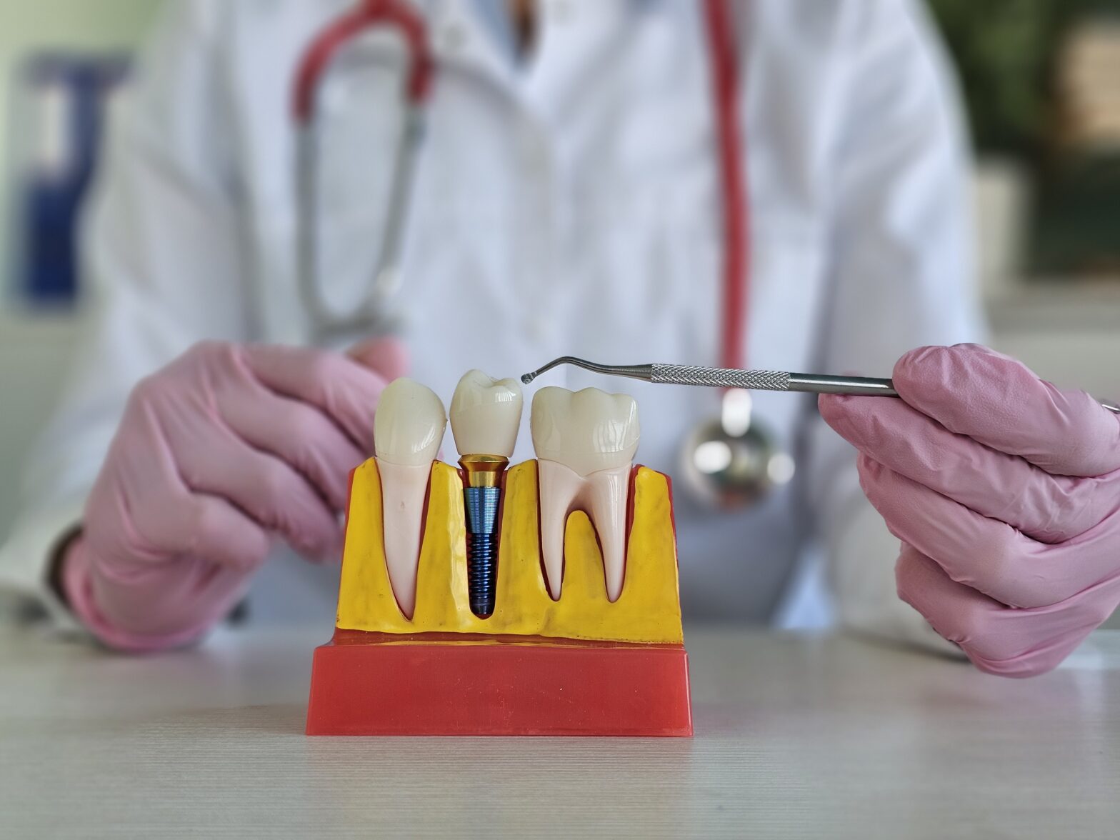 tratament implant dentar căzut