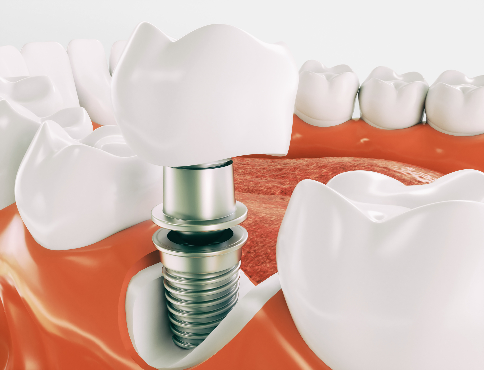 Implant dentar Straumann la clinica STOMESTET din Cluj