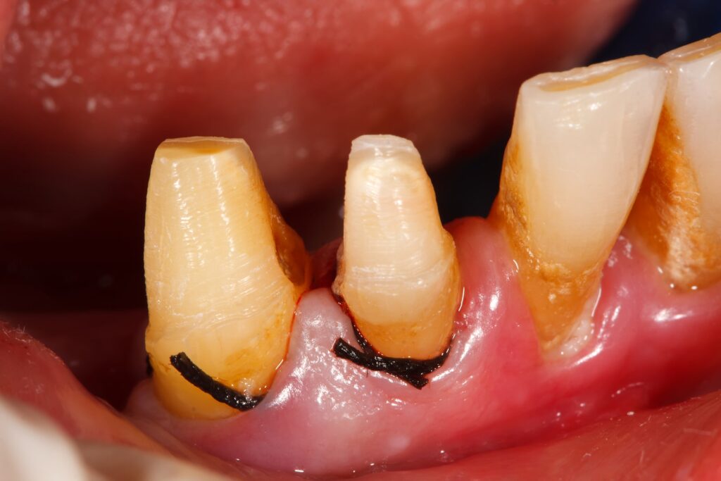 Retracție gingivală avansată – exemplu clinic tratabil la STOMESTET