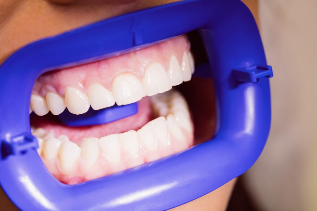 Tratament retracție gingivală pentru regenerare gingivală
