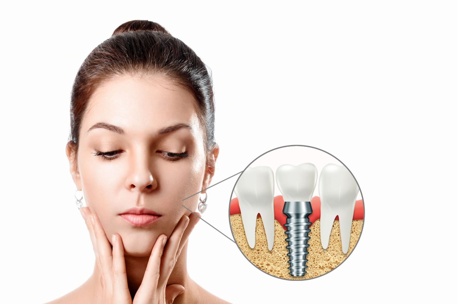 Stabilitatea unui implant dentar evaluată de medic în Cluj