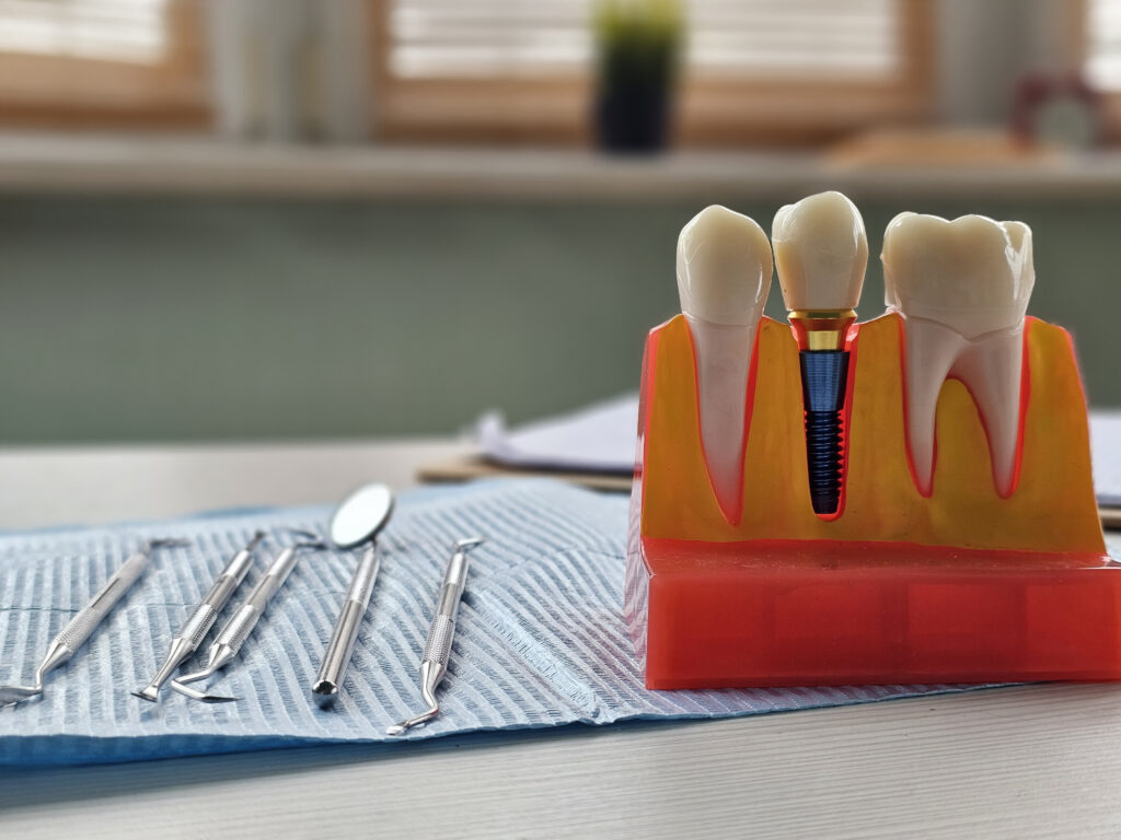 Planificare digitală pentru implant dentar frontal la STOMESTET Cluj