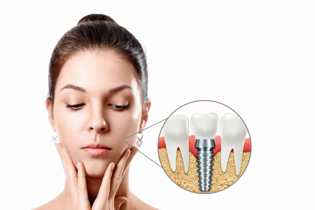 Aspectul gingiei după implant dentar în timpul procesului de vindecare, Cluj