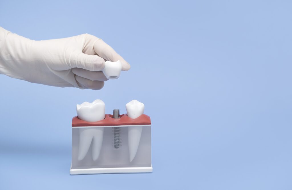 Coroana pe implant dentar fixata prin surub protetic la STOMESTET Cluj