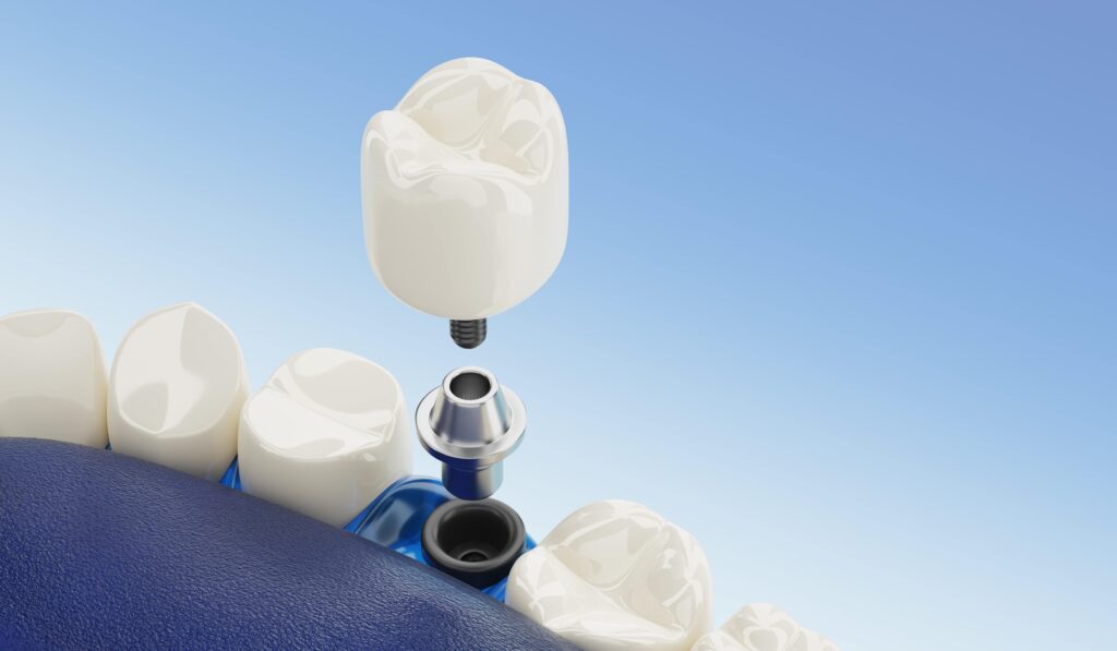 Fixare coroana de implant prin cimentare la clinica STOMESTET Cluj