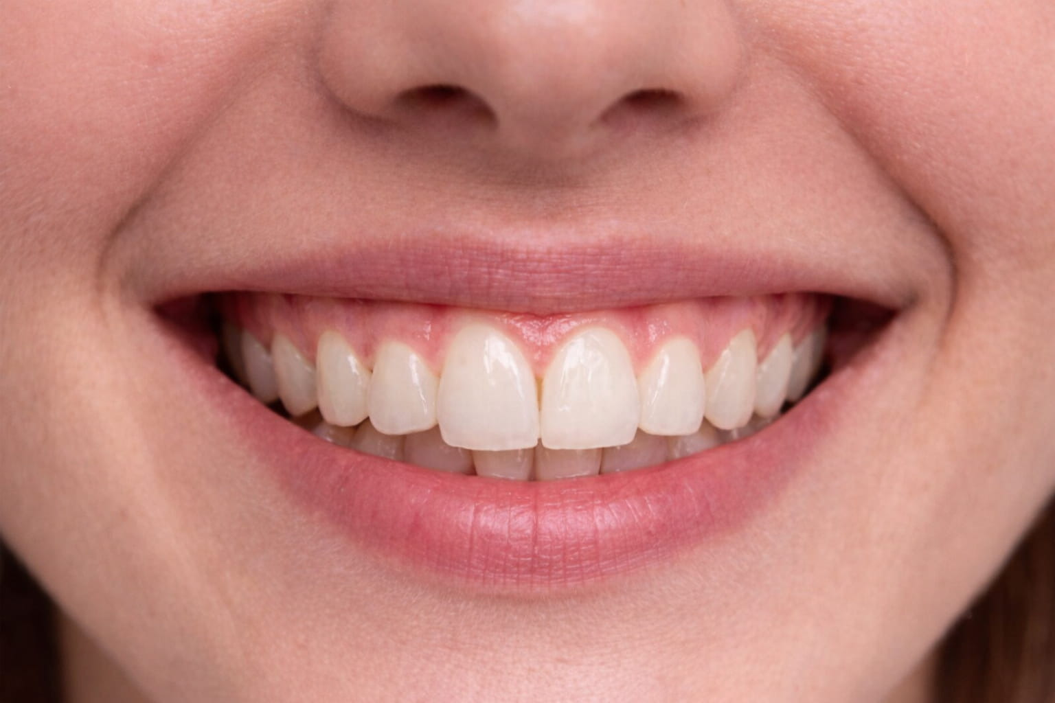 Pacient cu ocluzie adâncă severă, dinții superiori acoperă excesiv incisivii inferiori la STOMESTET Cluj