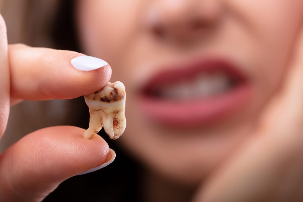 Scoți sau salvezi dintele extracție dentară Cluj procedură STOMESTET