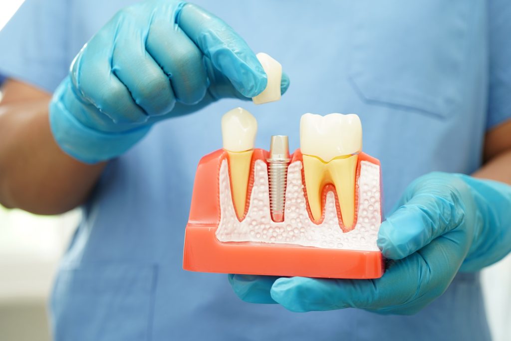 Implant vs proteză dentară STOMESTET Cluj rezultat implant dentar