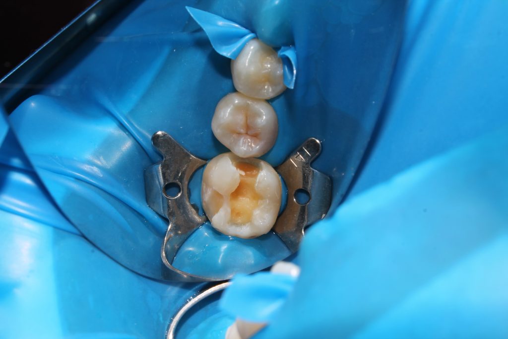 Plombă dentară Cluj realizată la STOMESTET pentru tratarea unei carii