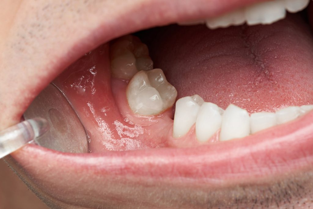 Cât timp poți sta fără un dinte lipsă înainte de consultația pentru implant dentar la STOMESTET Cluj