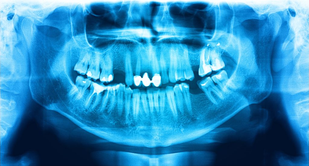 Cât timp poți sta fără un dinte lipsă dacă medicul verifică osul și mușcătura la STOMESTET Cluj