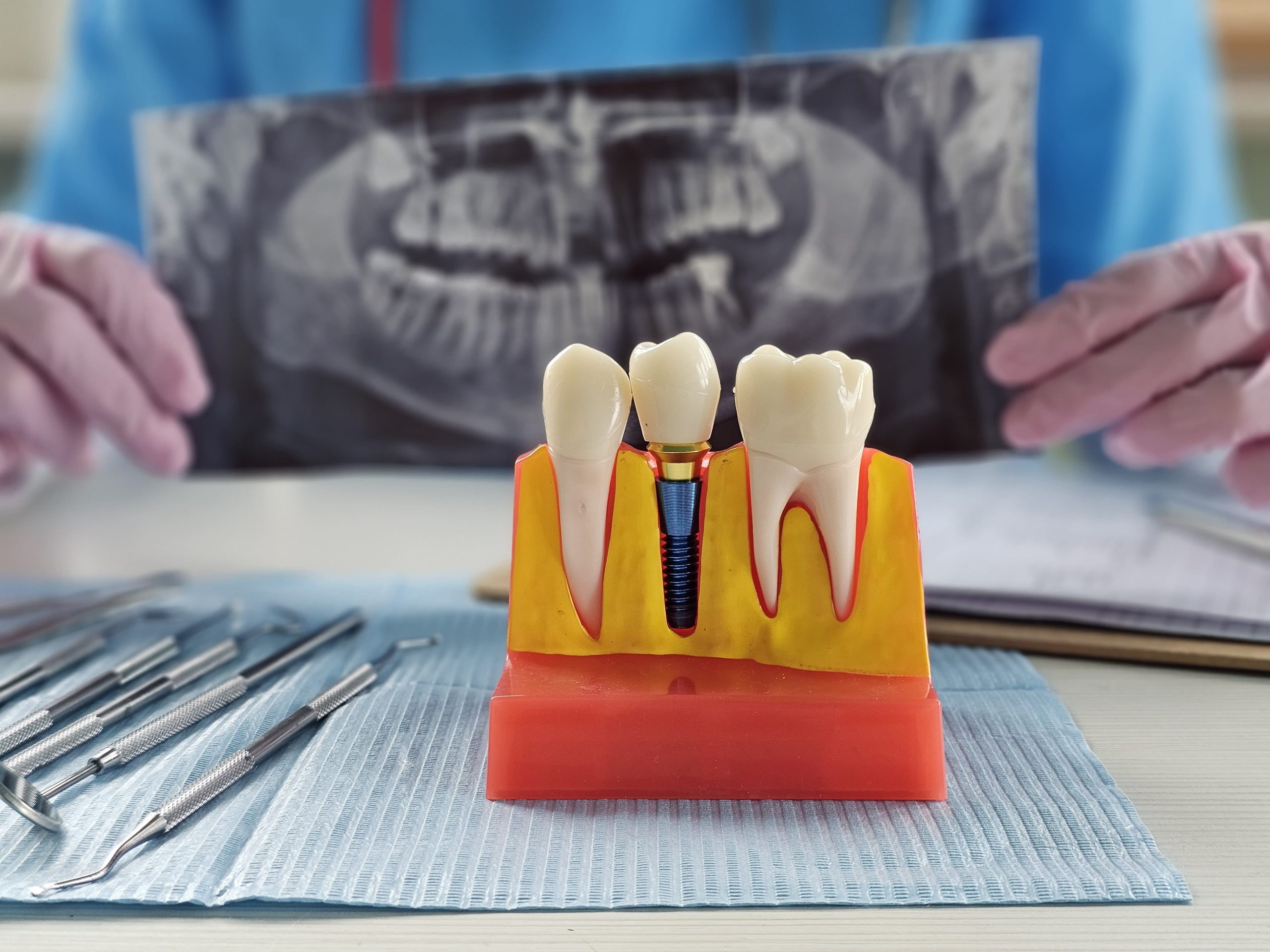 Implant dentar MEGAGEN la STOMESTET Cluj în timpul consultației pentru restaurarea zâmbetului