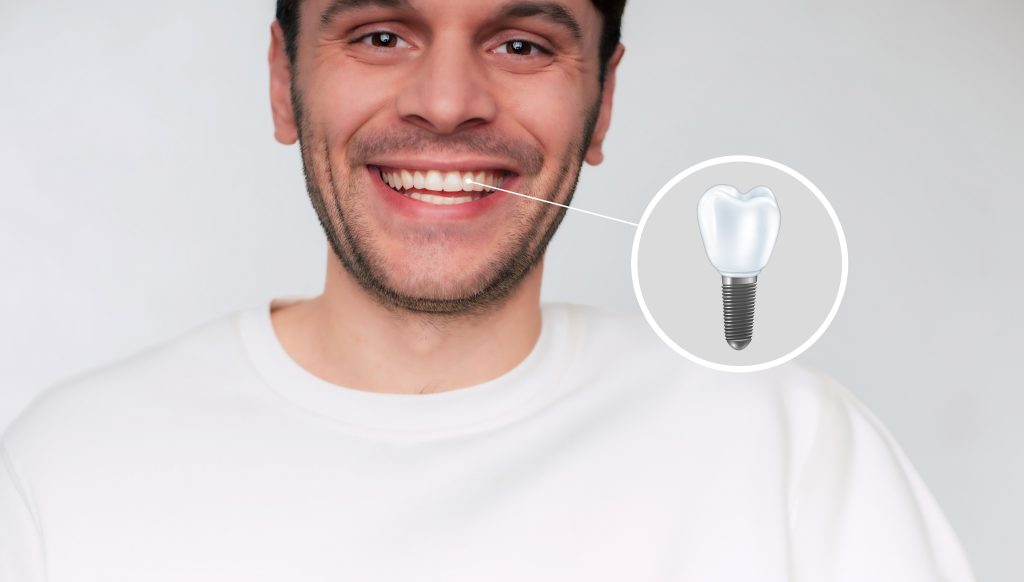 Implant dentar MEGAGEN cu rezultat estetic natural obținut la STOMESTET Cluj