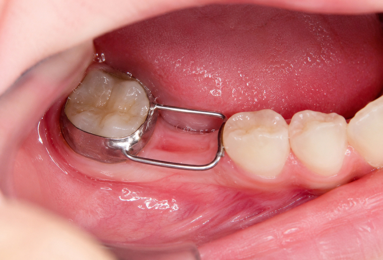Menținător de spațiu dentar fix montat la un copil în cadrul STOMESTET Cluj-Napoca