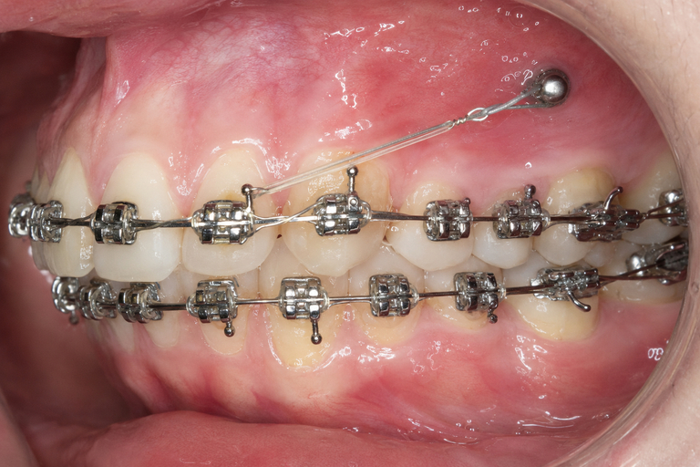 Montarea unui mini-implant ortodontic în timpul tratamentului cu aparat dentar în Cluj