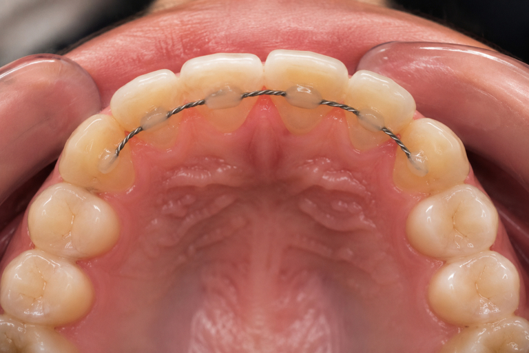 Retainer fix după aparat dentar la un pacient din Cluj