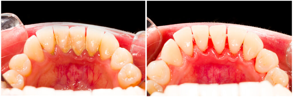 Rezultat după detartraj dentar și igienizare profesională la STOMESTET