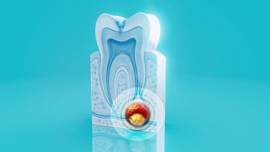 Caz endodontic complex cu canal dentar calcificat în Cluj-Napoca