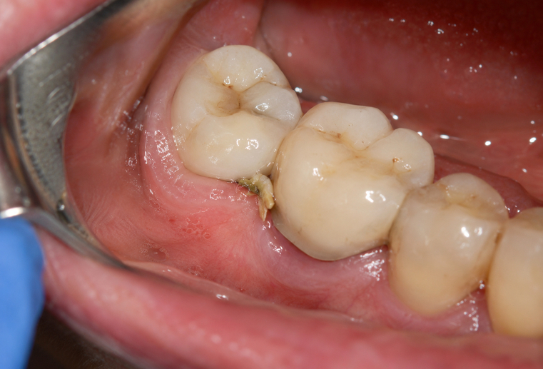 Resturi alimentare acumulate lângă coroana unui implant dentar