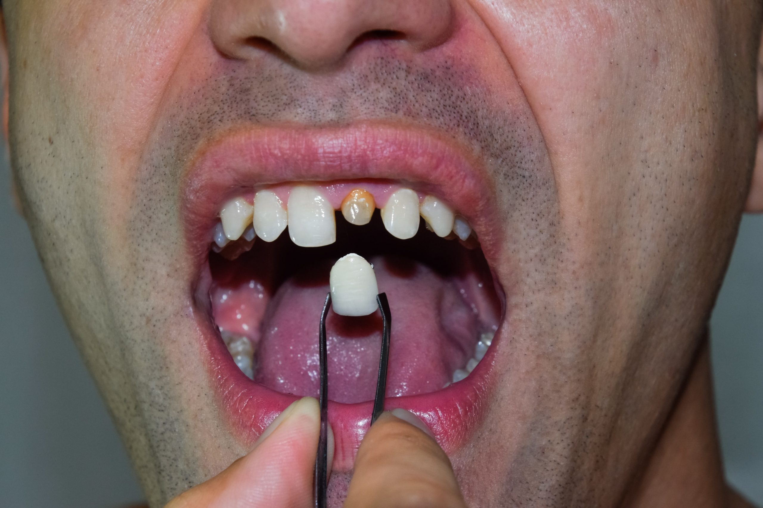 Coroana dentară a căzut – coroană desprinsă și dinte frontal descoperit