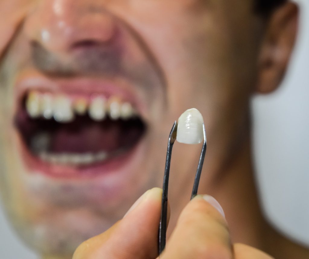 Coroană dentară ținută cu penseta, cu dintele frontal în fundal
