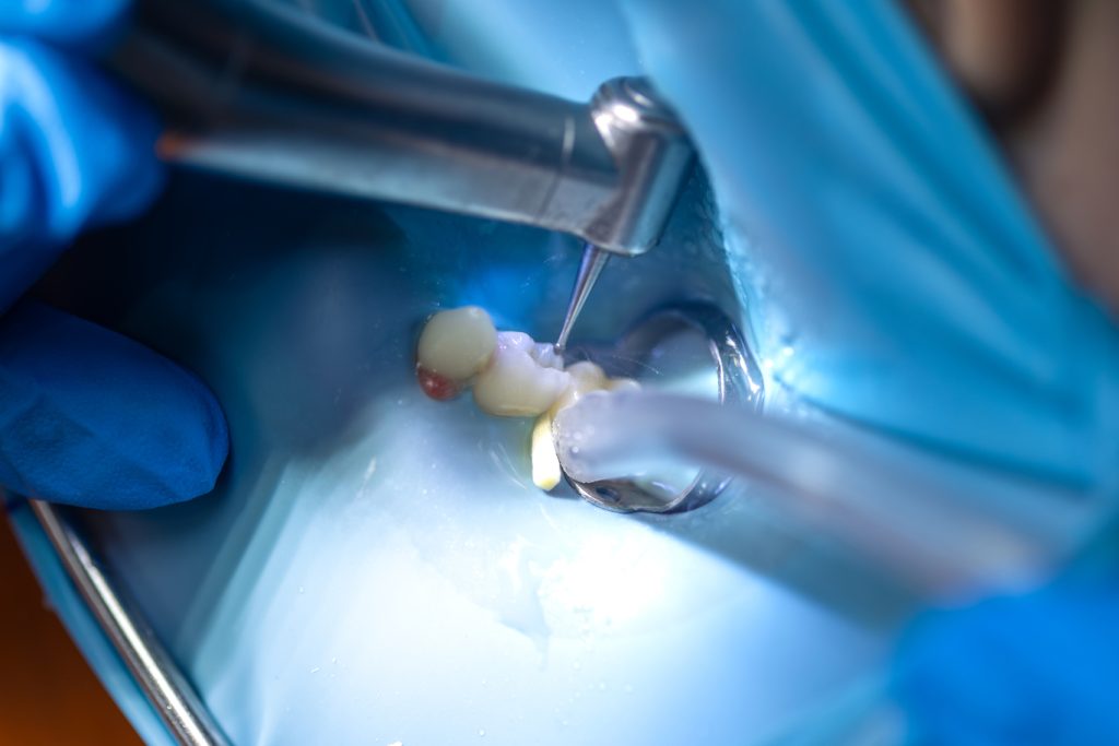 Dinte izolat cu digă dentară pentru tratament endodontic
