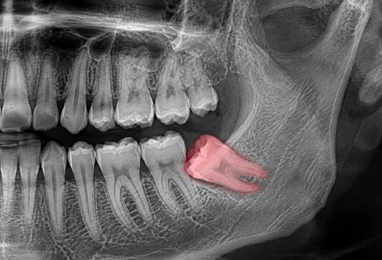 Radiografie dentară cu molar de minte inclus, în poziție orizontală