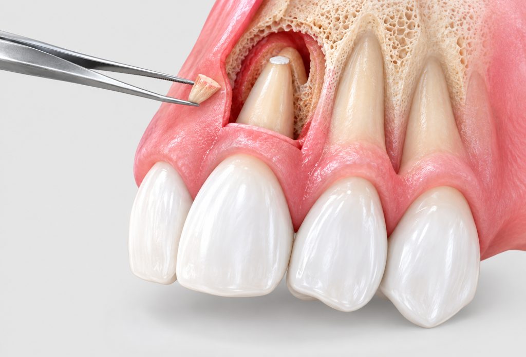 Rezecția apicală ilustrată prin îndepărtarea vârfului rădăcinii dentare