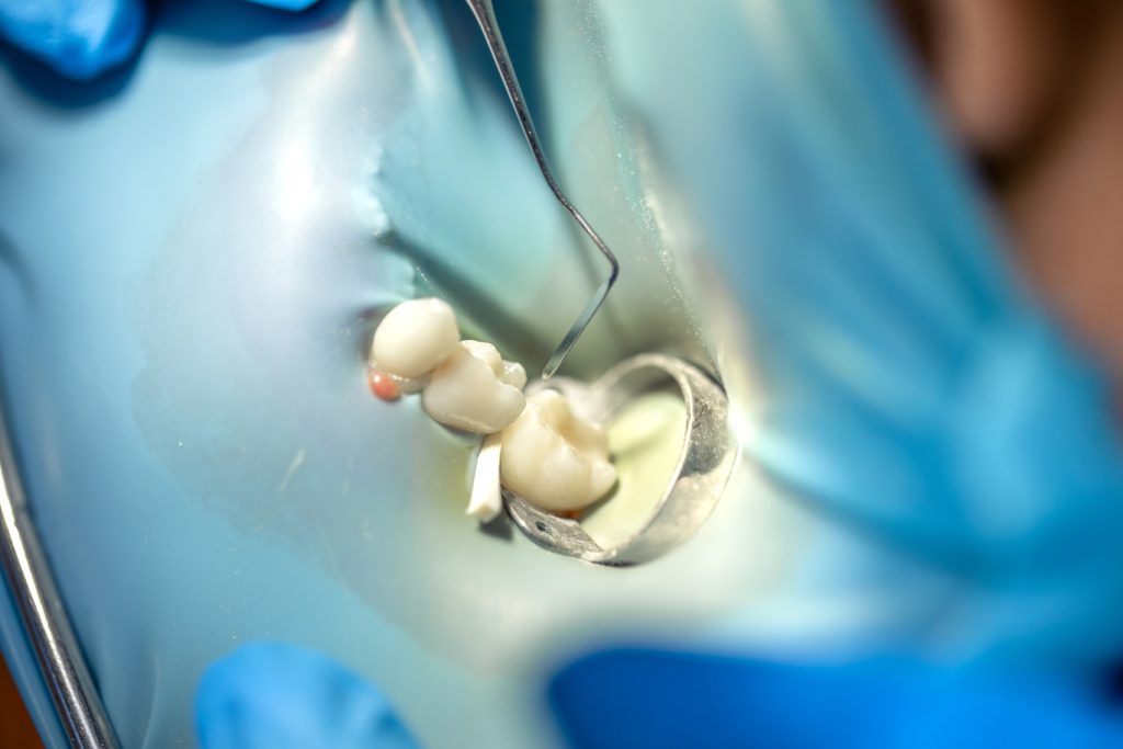 Tratament de canal cu diga dentară într-un cabinet stomatologic din Cluj-Napoca